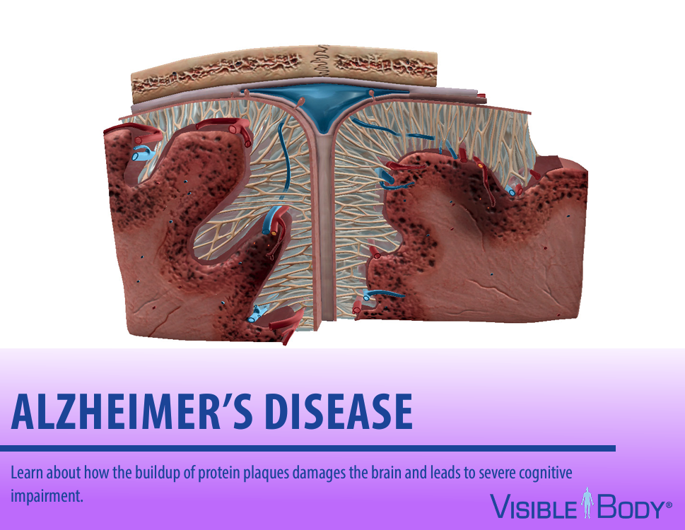 Alzheimer's Disease study guide showing an image of the brain and the caption "Learn about how the buildup of protein plaques damages the brain and leads to severe cognitive impariment."